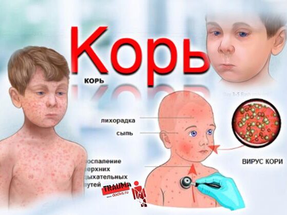 Риски отказа от прививки против кори